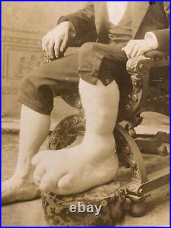 Rare Medical & Anatomical Curiosity Ohio Big Foot Boy Antique Photo Oddities